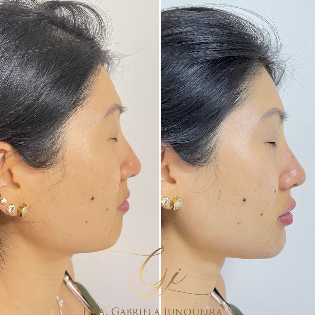 Dra. Gabriela Junqueira Harmonização Facial #1