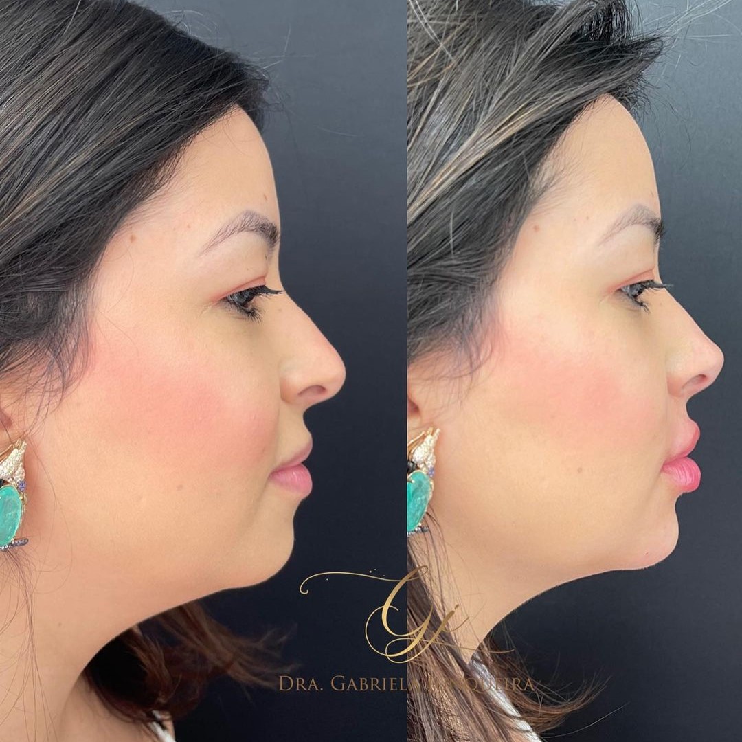 Dra. Gabriela Junqueira Harmonização Facial #4