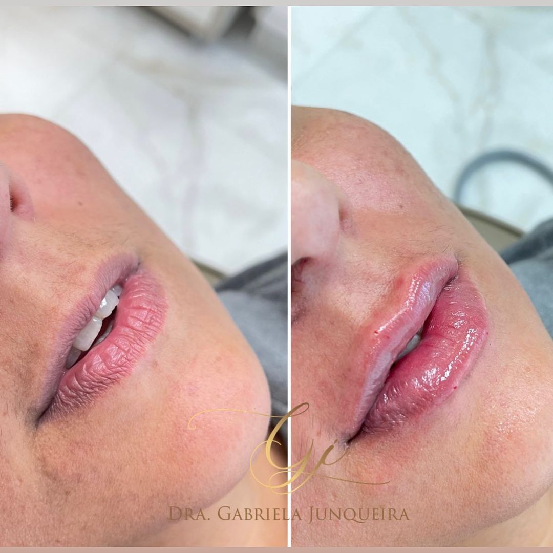Dra. Gabriela Junqueira Preenchimento Labial #1