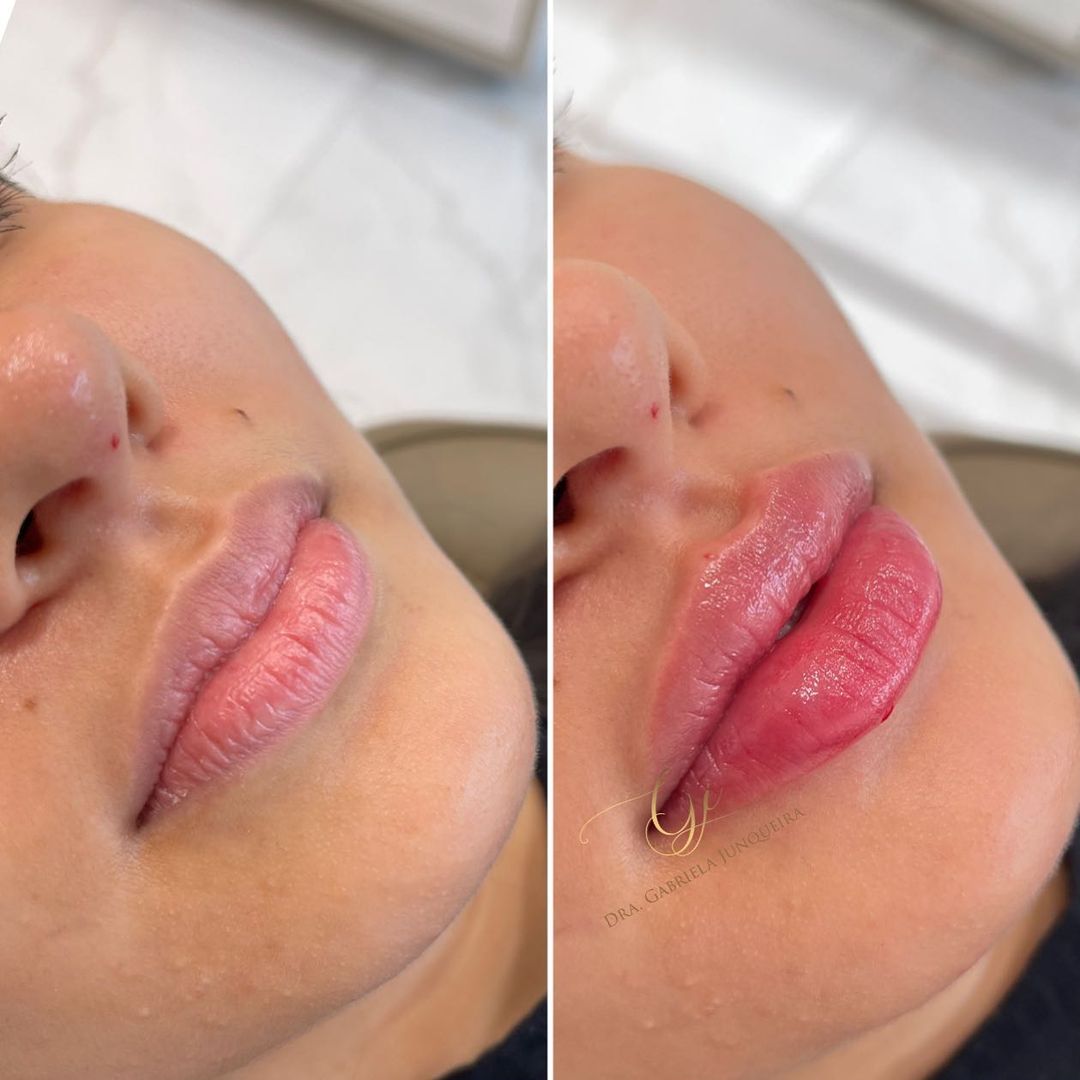Dra. Gabriela Junqueira Preenchimento Labial #2