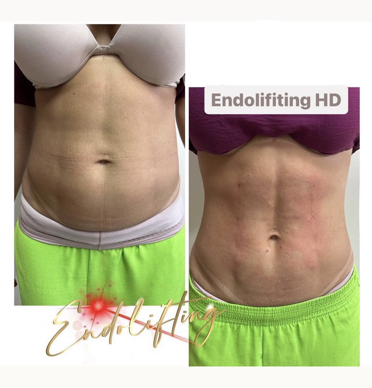 endolifiting hd