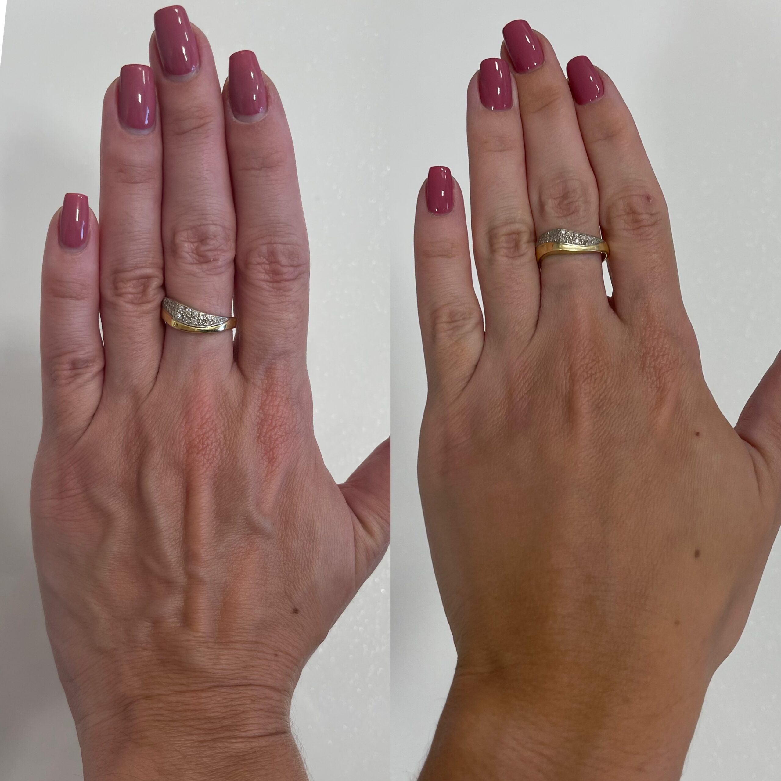 rejuvenescimento de mãos